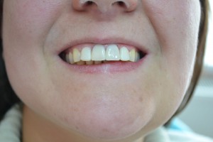 Выполнена эстетическая реставрация зубов